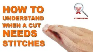 HOW TO UNDERSTAND WHEN A CUT NEEDS STITCHES - XTREME TRUTH (FIRST AID AND EMERGENCY HEALTH CARE)