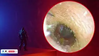 The Truth About earwax Will Shock You. How to remove earwax from ear, earwax extractions