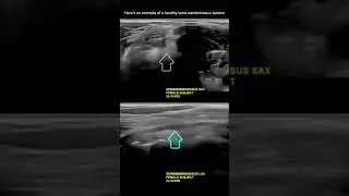 #ultrasound Guided Interventions: Healthy Images (Semi-Membranosus Tendon)