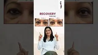 How to Recover from #Blepharoplasty | Plastic Surgeon's Guidance on #EyelidSurgery Recovery