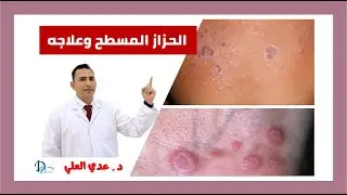 الحزاز المسطح وعلاجه || lichenplanus