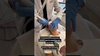 Fractionated CO2 laser to erase under eye wrinkles #antiaging #laser #undereyes #wrinkles