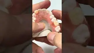 When two teeth missing from anterior and posterior