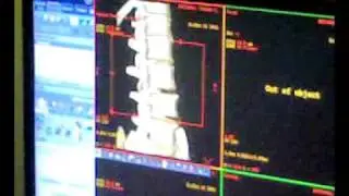 OLCMC BRIGHTSPEED 16 SLICE CT CAN