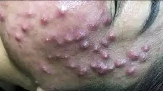 Relax every day with Acne treatment with TM Queen yt#20025