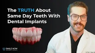 Same Day Teeth Implants: The Truth Behind Instant Smiles