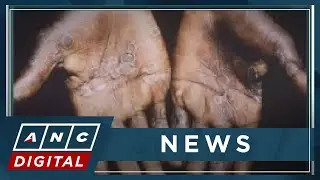 Monkeypox in PH: Expert talks transmission, symptoms | ANC