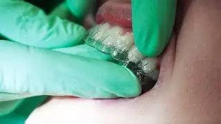 Invisalign day 1 - Folije za ispravljanje zuba