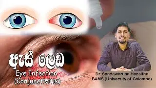 ඇස් ලෙඩ (Eye Infection / Conjunctivitis)