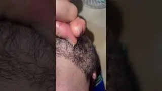 Ingrown hairs can sometimes turn into a hard #largepores #enlargedpores #seborrheickeratosis