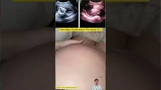 Twins Baby Movements In The womb 👣🤩 | Nursing Educational video #babycare #pregnancy #twinmoments