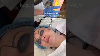 Anti-Aging Fractional Laser Treatment in Montreal | Remederm | Traitement au Laser Fractionn&eacute;