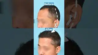 7 Months of Hair Transplant Results | 3000 Grafts of Hair Transplant with Boosted FUE Technique