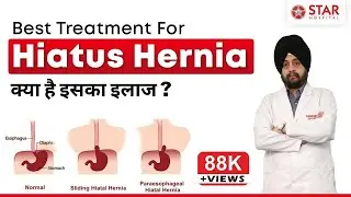Hiatus Hernia Treatment हाय्टस हर्निया GERD Lax LES Reflux Disease Acidity ऐसिड रिफ़लक़्स का इलाज