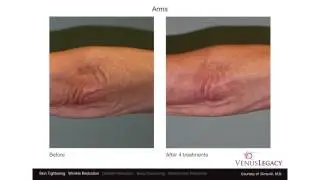 Venus Legacy Treatment Before & After - Arms