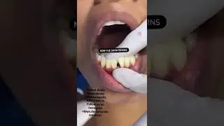 Gaps between teeth ,Instant smile in 30 min , follow Instagram page vijaya.dental ( smile creators)