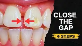 How to Close a Front Tooth Gap (Diastema) | 4 Steps You MUST Know