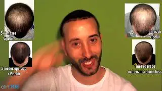 Evolución de mi trasplante capilar a los 3 Meses. Cuento mi experiencia personal con cliniFUE