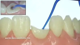 Fibrekleer Post Cementation