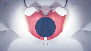 How Emsella Works | Pelvic Floor Strengthening & Incontinence Solution Explained at Chiswick Clinic