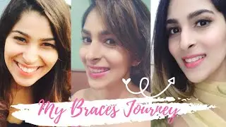 All about my braces journey-Cost, duration, FAQs, fun stories| Mascara and Muscles | Shruti Sethi