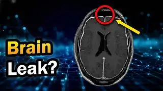 CSF-Venous Fistula: Why Headaches and Heartbeat in Your Ears Stop When Lying Down