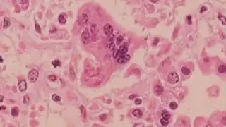Can a face mask prevent measles exposure? Doctor answers measles questions