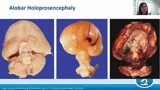AANP Teaching Rounds - February 24, 2021 - Pediatric Neuropathology: Malformations