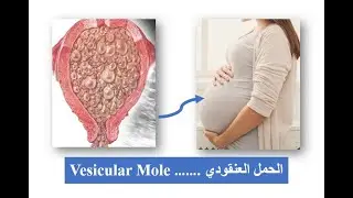 vesicular mole ..... الحمل العنقودى #الكويت_السعوديه_قطر_الأمارات_البحرين#nursingstudent  #pregnant