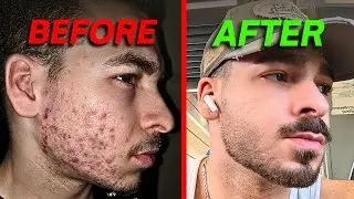 How I Cleared My Acne (2026)