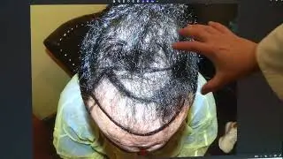 6.5-Month Hair Transplant Results | Natural Soft Hairline & Density Improvement