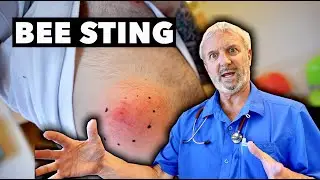 MASSIVE BEE STING! (What to Look Out for When You Get Stung) feat. My Son @bignoknow