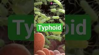 What is Typhoid? Symptoms, Causes & Prevention in 60 Seconds! #Shorts #Shorts #Typhoid