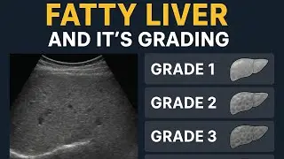 FATTY LIVER ultrasound!Grading of Fatty liver!Ultrasound finding of Fatty liver#ultrasoundmadeeasy86