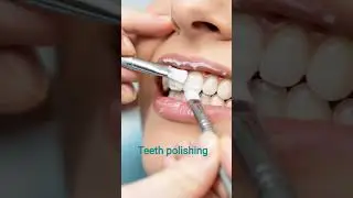 How teeth polishing procedure #shortsfeed #dentist #cosmeticdentistry #shortvideo #orthodontist
