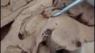 Human Brain Circumventricular Organs 6 - Subcommissural Organ - Sanjoy Sanyal