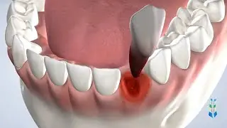 General Extraction in Springfield IL at Oral & Facial Surgeons of Illinois