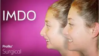 IMDO | Small lower jaw correction