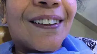 Successful Lower Fixed Teeth in 3 days - Focus Dental Care
