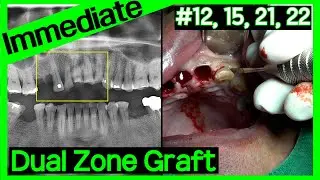 [Online Surgery] Upper anterior immediate implant and immediate provisionalization (AI Voice-over)