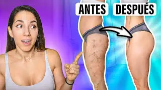 Los Mejores REMEDIOS Para Las VARICES En Las Piernas