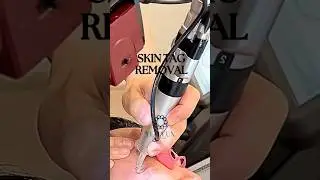 SKIN TAG REMOVAL | SKIN CLINIC IN DUBAI #skinlaser #skintreatment #koreanclinic #skintags #kbeauty