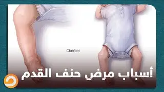 منتشر عند المواليد من الاطفال .. د. علاء الدين حبشي يحدد أسباب اصابة الأطفال بمرض حنف القدم