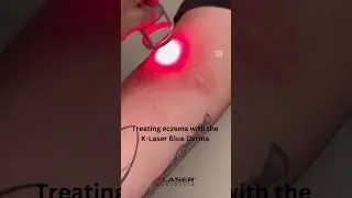 Eczema relief with K-Laser Therapy. Pain free. Drug free. Manage itchiness and redness