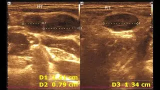 Enlarged Lymph Nodes in Child: Ultrasound Findings in Neck, Axilla, and Inguinal Region