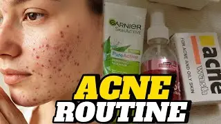 Simple Acne Routine | Acne Treatment at Home | Doorbeen