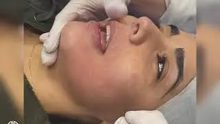 Upgrade your HYDRAFACIAL with the WET DIAMOND TIP