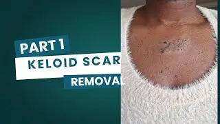 Keloid Scar Removal (No Surgery) Before & After Part 1 #keloid #keloidtreatment 