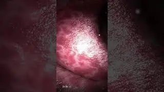 Полипэктомия толстой кишки (удаление полипов)