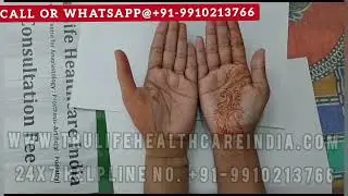 Best Thumb Prosthesis for complete Thumb Loss Amputee  or Partial Thumb Amputation  #nakliAngutha